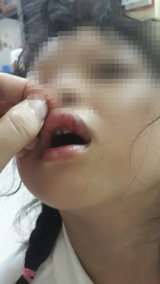 Hà Nội: Có hay không việc cô giáo đánh học sinh dập môi?