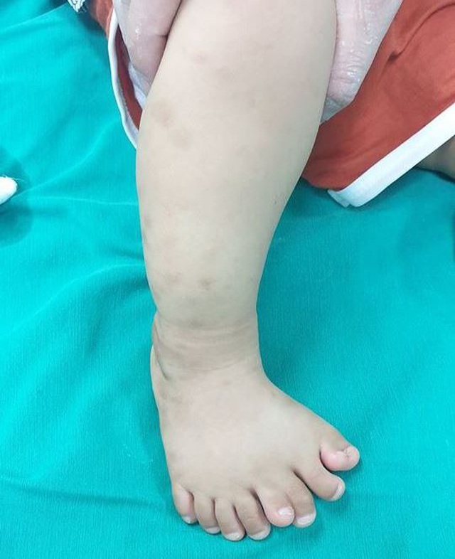 Thanh Hoá: Cậu bé có 9 ngón chân trên một bàn chân
