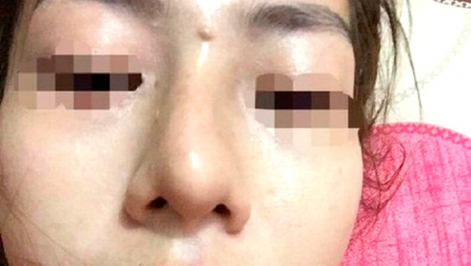 Vụ bé gái 13 tuổi tổn hại 42% sức khỏe khi đi nâng mũi: Có dấu hiệu bao che tội phạm?