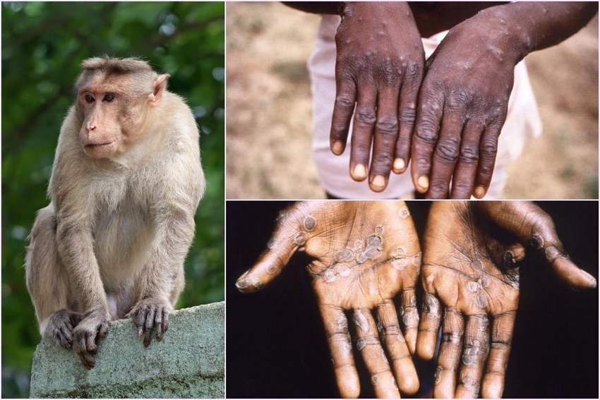 Hà Nội: Hướng dẫn chẩn đoán, điều trị và phòng bệnh đậu mùa khỉ