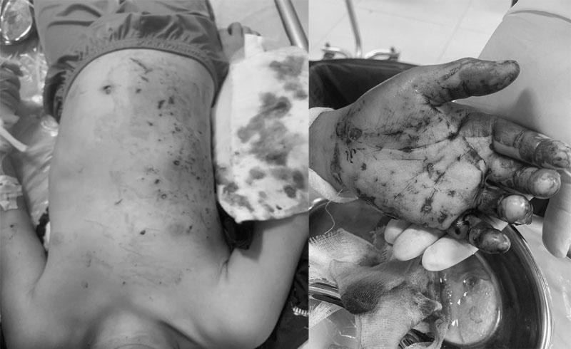 Quảng Ninh: Pin đồ chơi phát nổ, bé trai 10 tuổi đa chấn thương